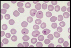 Pink inclusion bodies in blood cells