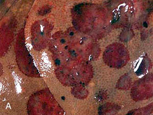Hemangiosarcoma metastasized to the liver