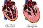 Thickening heart walls with hypertrophic hearts