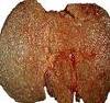 Human cirrhotic liver