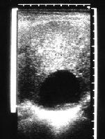 Hydatid cyst on ultrasound