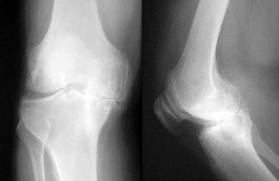 bad arthritis of the knee joint would preclude surgery