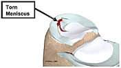 Tearing the cartilage inside the knee or stifle joint