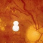 damage to the retina from high blood pressure