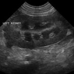ultrasound of a normal kidney