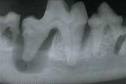 lysis bone round tooth root