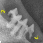 tooth resorption 2